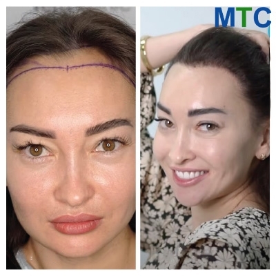 Before & After Hair Transplant for Women in Turkey