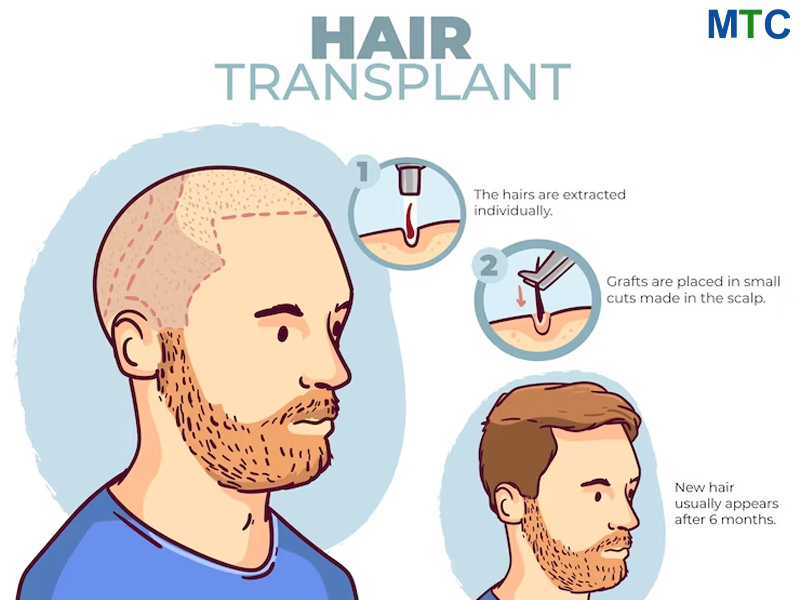 FUE Hair transplant procedure