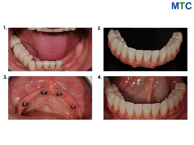 Full Mouth Restoration Process in Vietnam