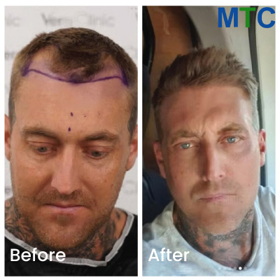 Istanbul Hair Transplant Before & After