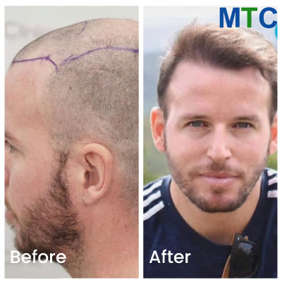 Hair Transplant Istanbul Results