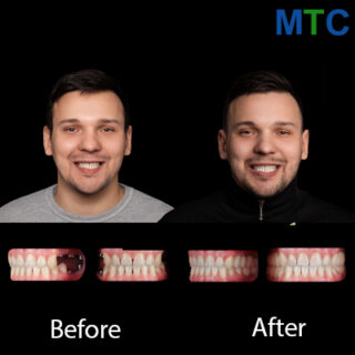 Multiple dental implants in Chisinau, Moldova