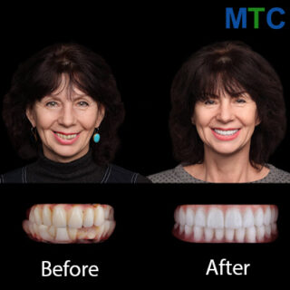 Same day dental implants in Chisinau - Before & After
