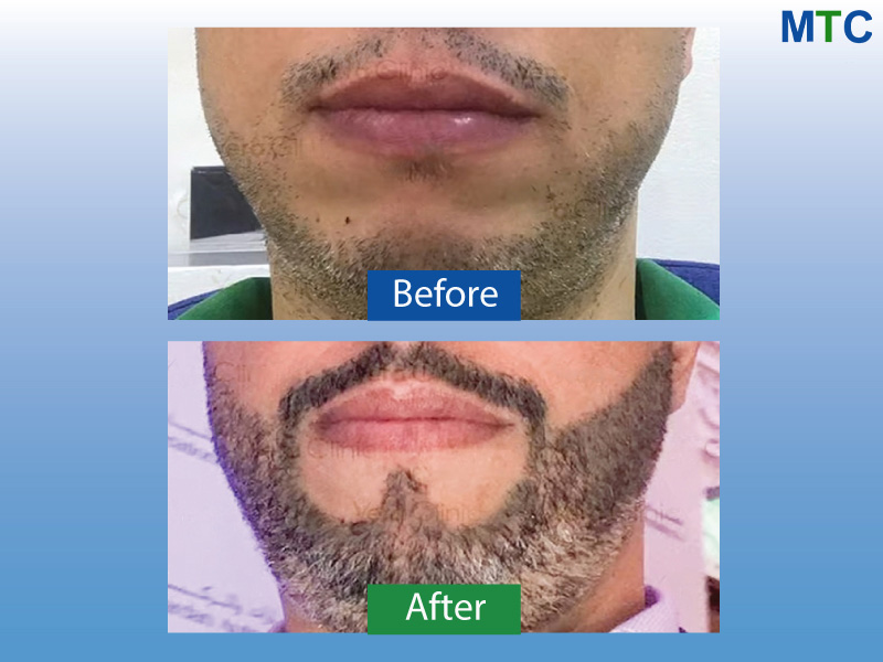 Beard Transplant Turkey Results