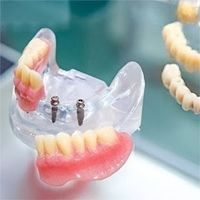 Mini Dental Implant