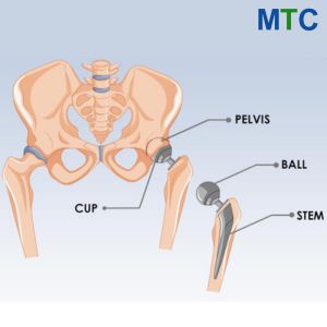 Artificial implants replacing natural hip parts