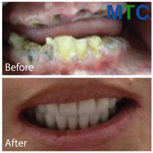 All on 4 dental implants in Los Algodones - Before & After