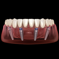 All-on-4-Implant