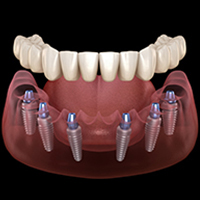 All-on-6-Implant