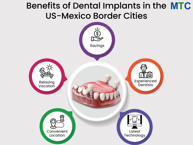Benefits-of-Dental-Implants-in-the-US-Mexico-Border-Cities