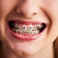 Dental braces in Turkey