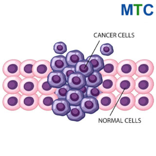 Cancer cells | Stem cell therapy in Mexico
