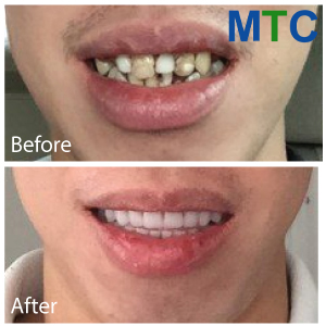 Cosmetic dentistry in Los Algodones - Before & After