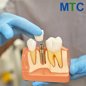 Dental Procedure | Dental Crown