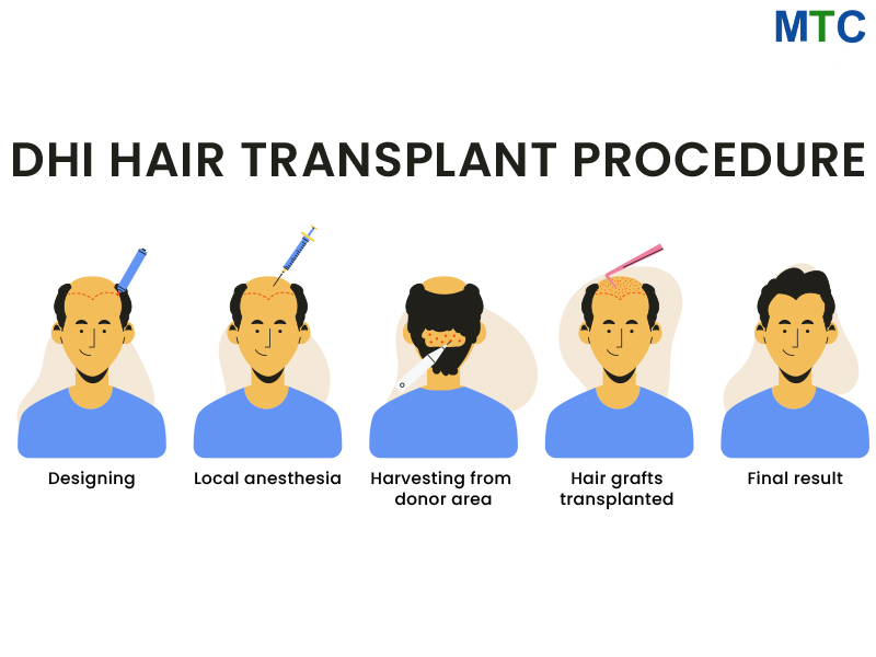 DHI Hair Transplant Procedure