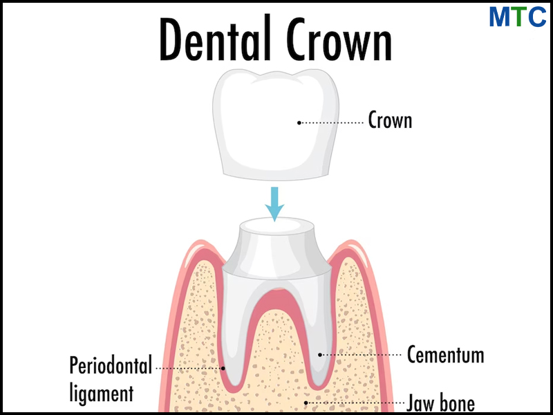 Dental Crown | Constanta, Romania