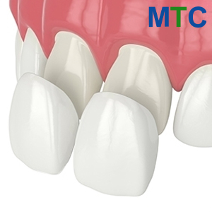 Dental Veneers in the Upper Jaw