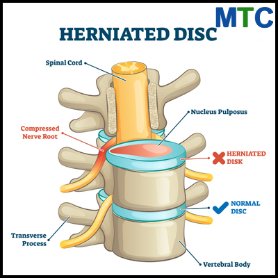Herniated Disc Treatment in Mexico