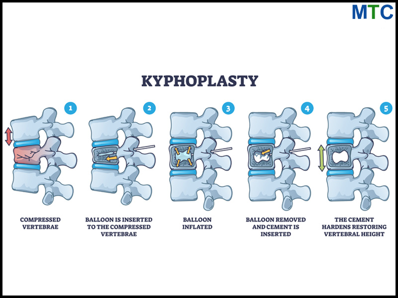 Kyphoplasty in Mexico