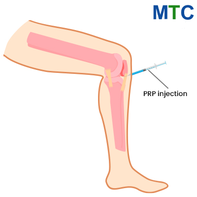 PRP injection