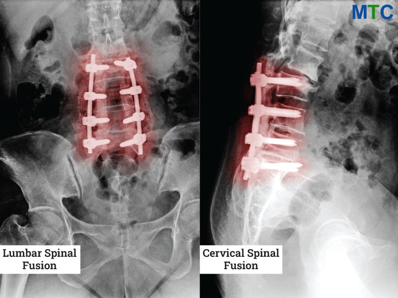 Lumbar Spinal Fusion vs. Cervical Spinal Fusion