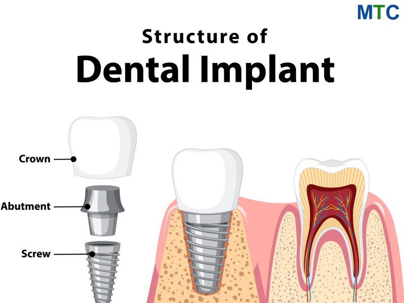 Structure-of-Dental-Implant