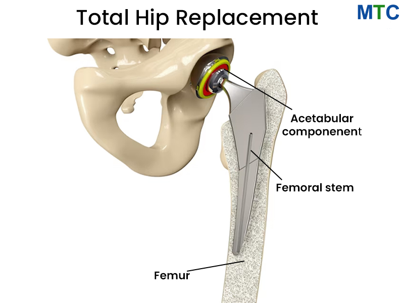 Total Hip Replacement in Tijuana, Mexico
