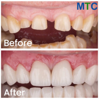 Before and After Dental Crowns in Turkey - Pic 4