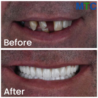 Before and After Dental Crowns in Turkey - Pic 3