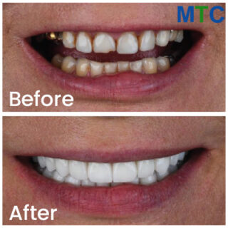 Dental Crown Before and After Turkey - Pic 1
