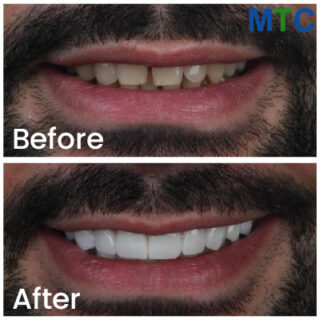 Dental Crown Before and After Turkey - Pic 2