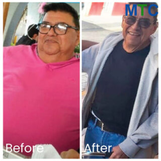 Before & After Pictures of Patients Who Got Weight Loss Surgery in Guadalajara