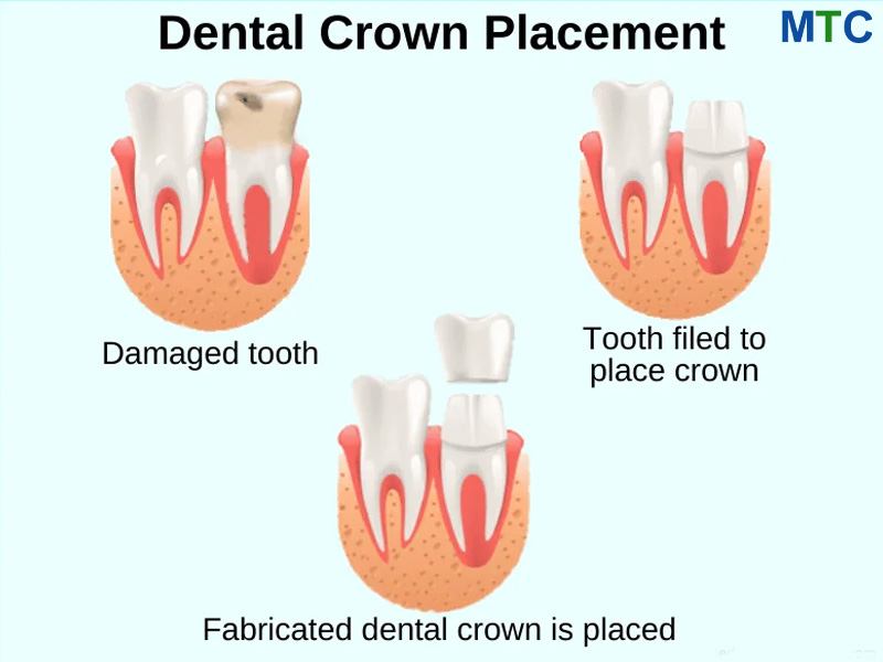 Tooth preparation and fixing a dental crown