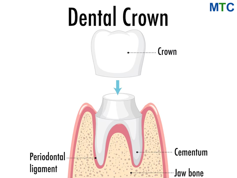 Dental crown as a tooth cap