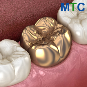 Gold crown between natural teeth