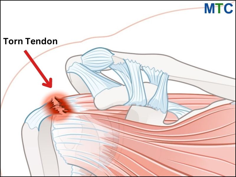 Rotator cuff injury is a torn tendon