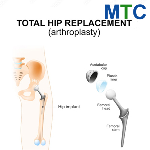 Total Hip replacement surgery