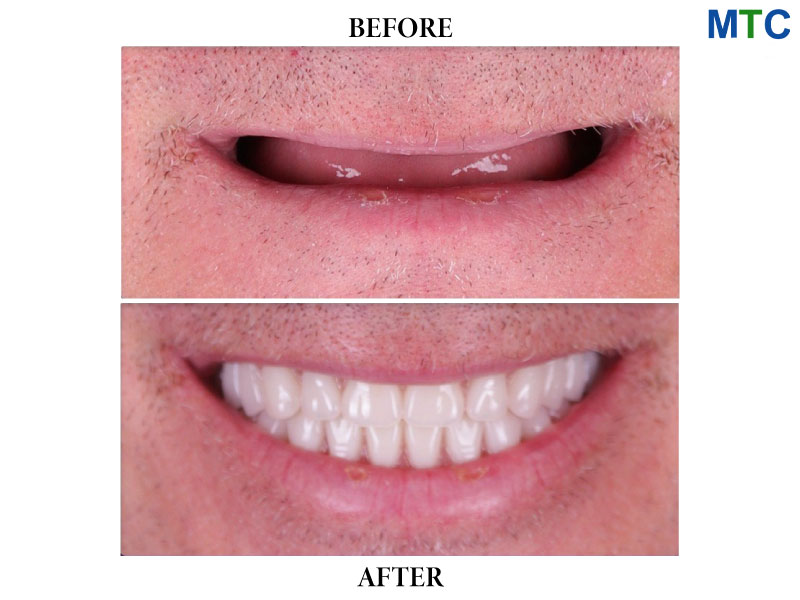 All-on-4-Dental-Implants-Before-After.jpg