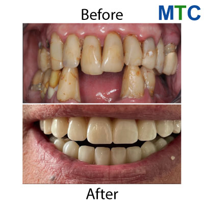 All on 4 Dental Implants in Bucharest, Romania: Before & After