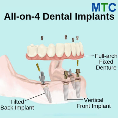 All on 4 Dental Implants Romania