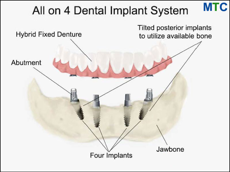 All on 4 Dental Implant Romania