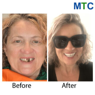 All on 6 dental implants in Cancun - Before & After