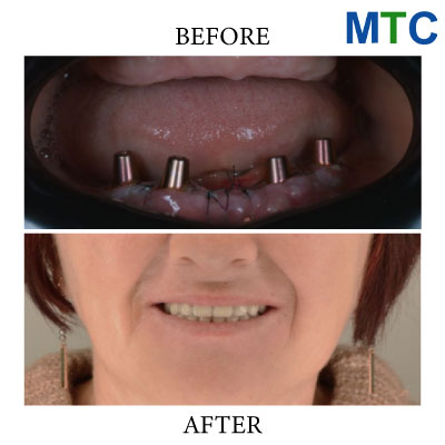 All on 4 Dental Implants Romania | Before & After