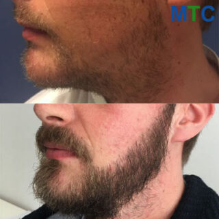 Before After Beard Transplant Istanbul