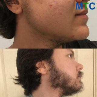 Before After Beard Transplant Istanbul