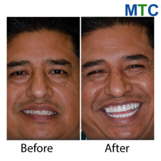 Dental veneers in Cancun, Mexico- Before & After