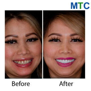 Dental veneers in Cancun, Mexico - Before & After