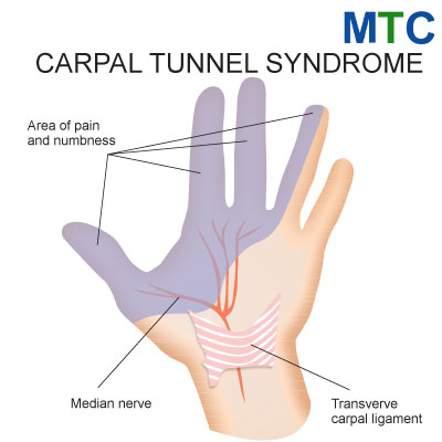Carpal Tunnel Syndrome Surgery in Mexico