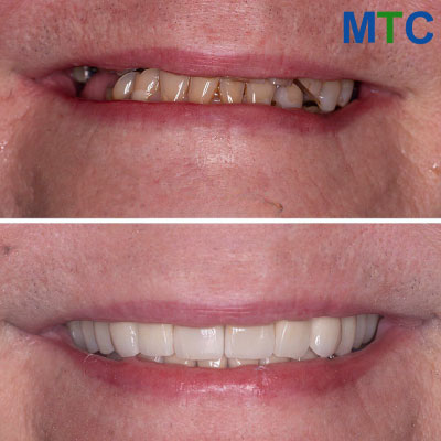 Before & After Getting Dental Crowns in Mexico Near Yuma, Arizona