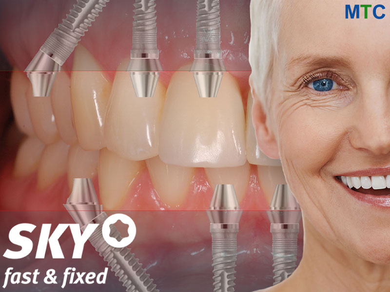 Fast & Fixed | All on 4 Dental Implants Romania